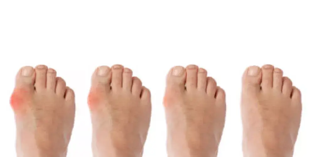 النقرس