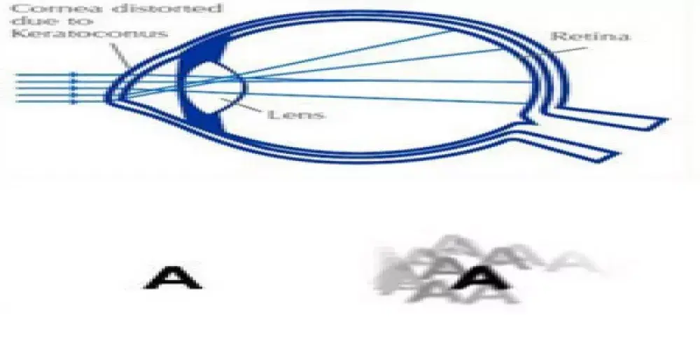 القرنية المخروطية 