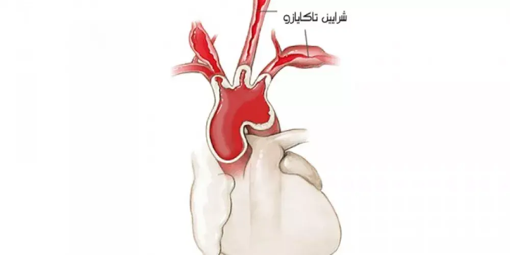 متَلاَزمةُ تاكايازو Takayasu Syndrome 