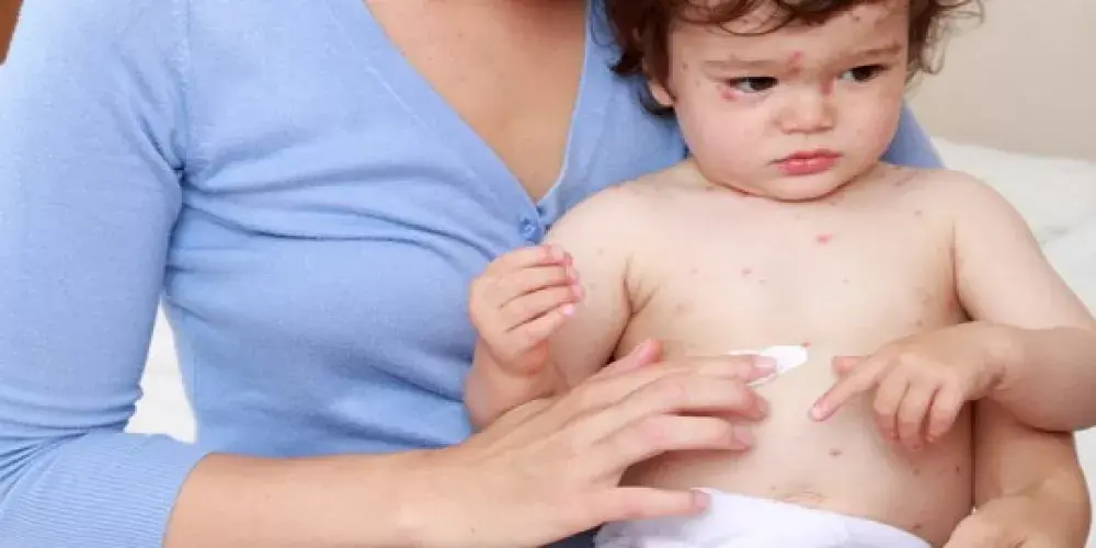 جدري الماء عند الأطفال