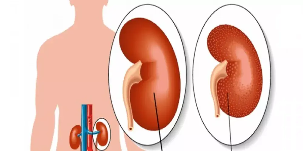 مخاطر اعتلال الكلى السكري وعلاجه