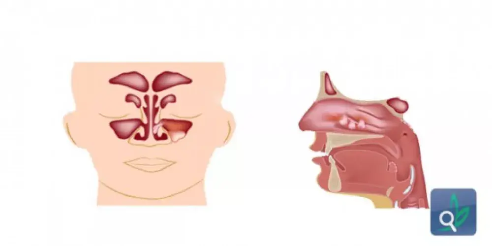 السلائل الأنفية مشكلة تتطلب دقة التشخيص 