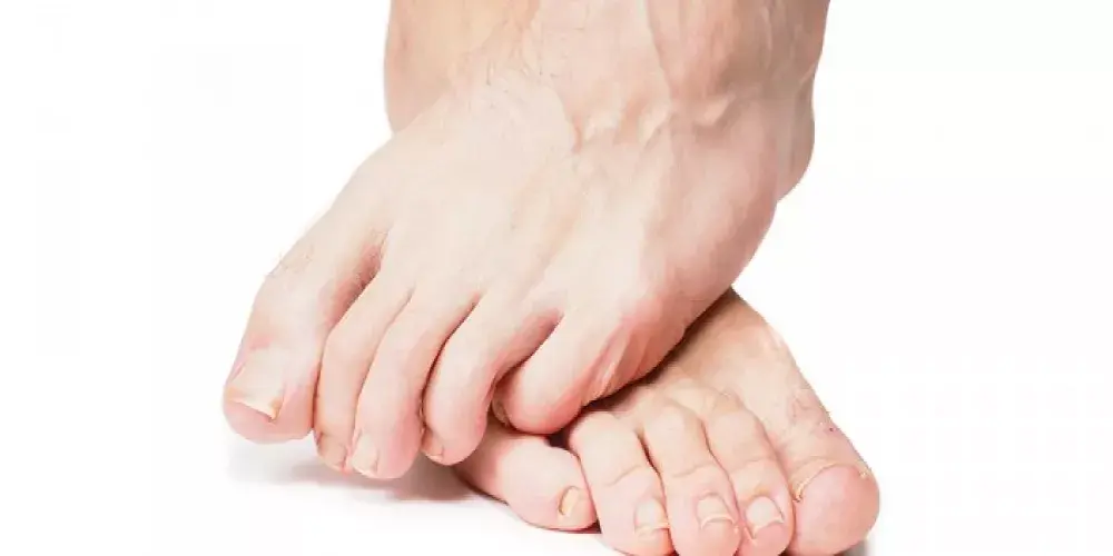 القدم السكرية مفاجئة غير سارة لمريض السكري 