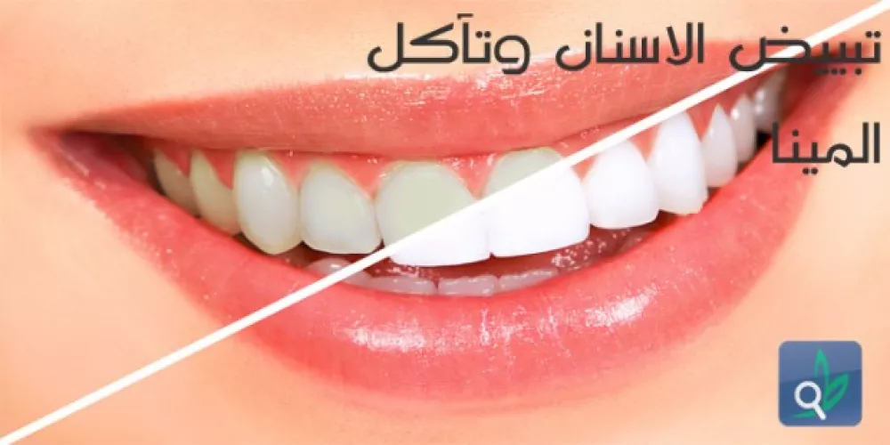 تبييض الأسنان : ابتسامة جميلة على حساب الأسنان 