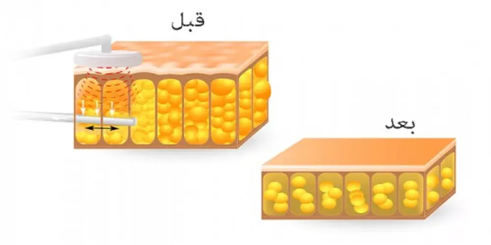 تقنية جديدة في شفط الدهون