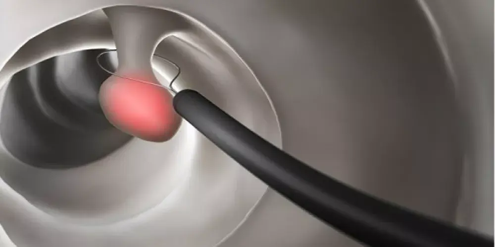 أورام القولون والمستقيم