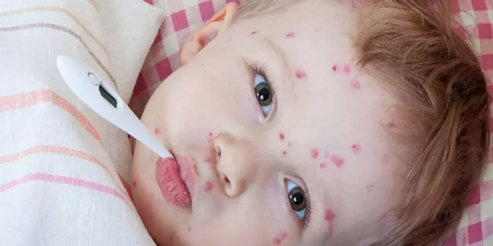 الحصبة وتداعياتها المرضية ودور فيتامين أ في الحد من مخاطرها 