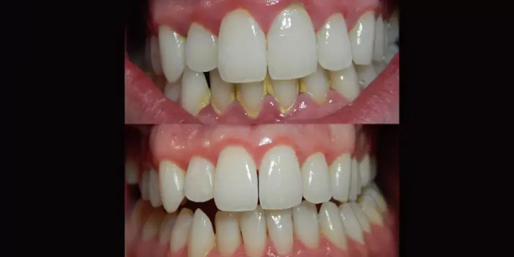 التهاب اللثة