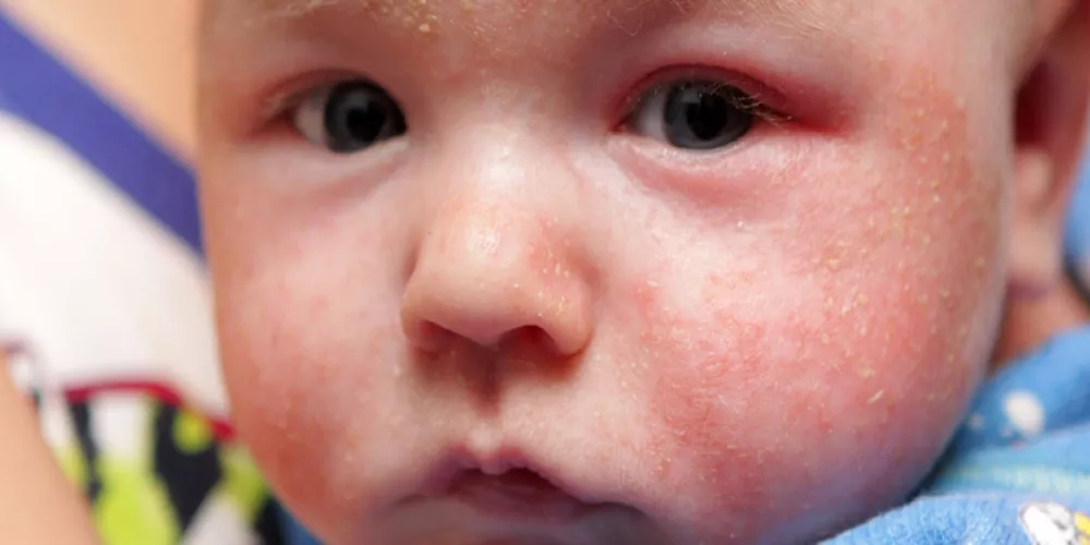 الأكزيما - انواعها وعلاجها