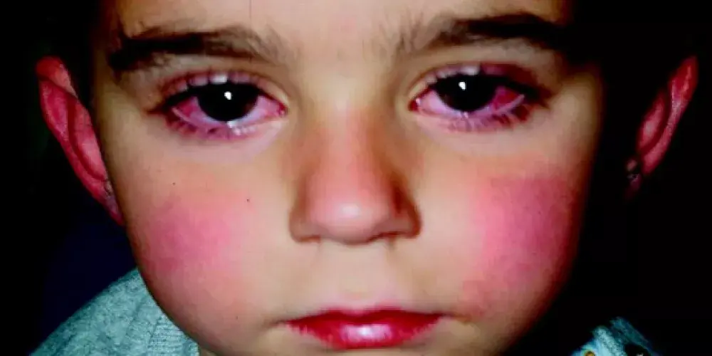 داء   كاواساكي  :    Kawasaki   Disease  