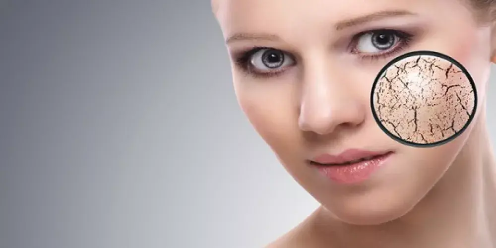 متلازمة شوغرن (جوغرن) Sjogren's Syndrome