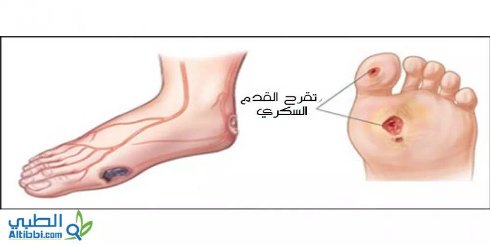 قرحة القدم السكرية