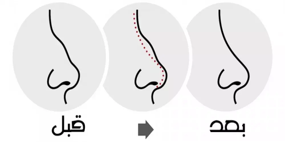 عمليات تجميل الانف و تقويم الحاجز الانفي