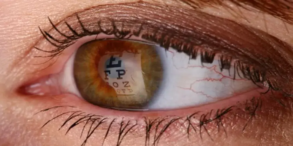 القرنية المخروطية: اكتشفها قبل فوات الآوان