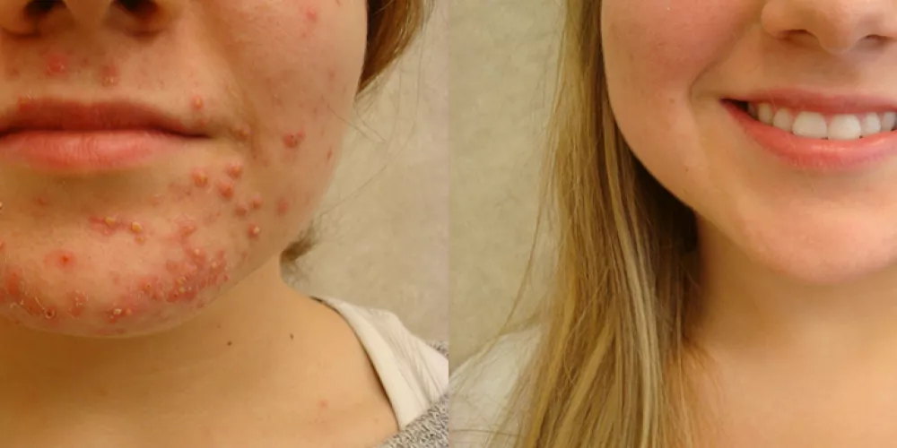 الايزوترتينوين