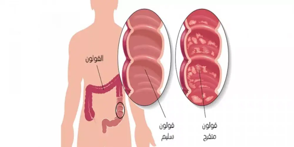 تعرف على التهاب القولون التقرحي