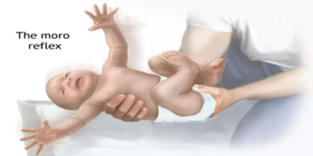 خلع الكتف عند الاطفال حديثي الولادة
