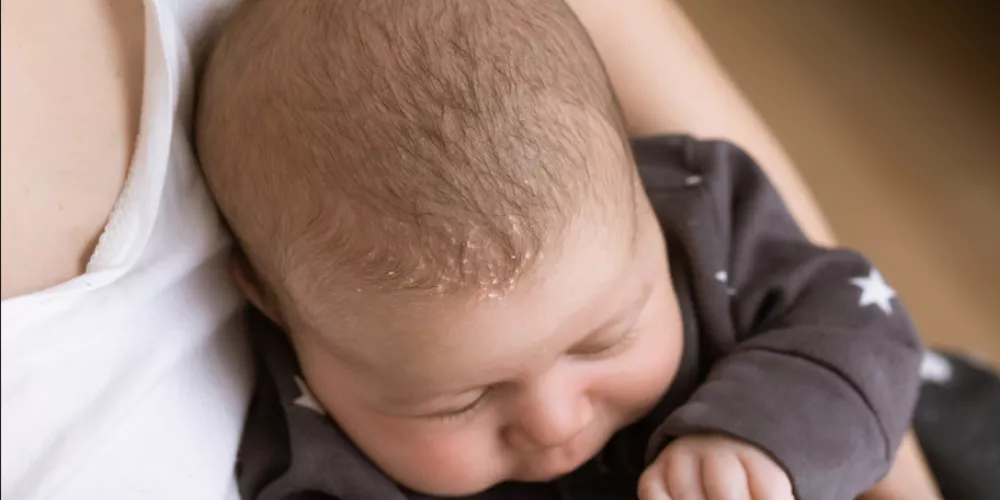 قشرة راس الرضيع مشكلة تقلق معظم الأمهات