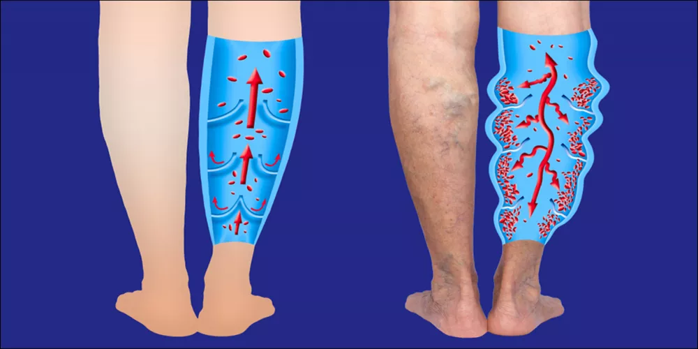 جلطة الأوردة العميقة )DVT( 