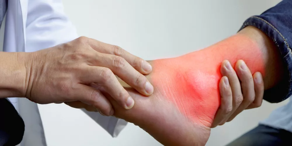 كل ما تود معرفته عن النقرس ( داء الملوك)