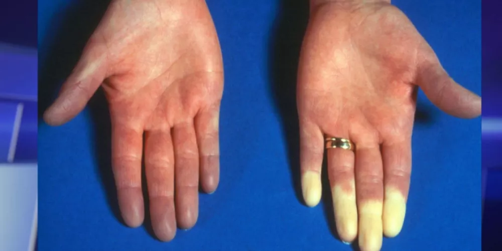 ظاهرة راينود وعلاقتها بالطقس البارد