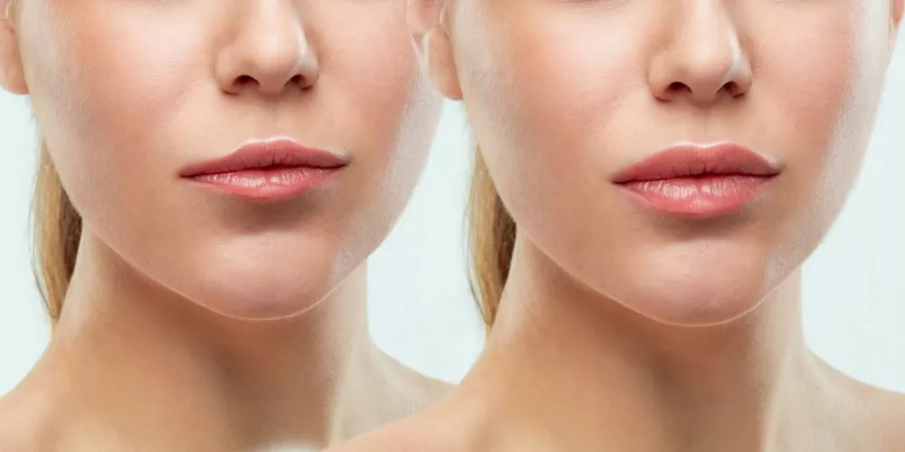 أسئلة شائعة حول الفيلر