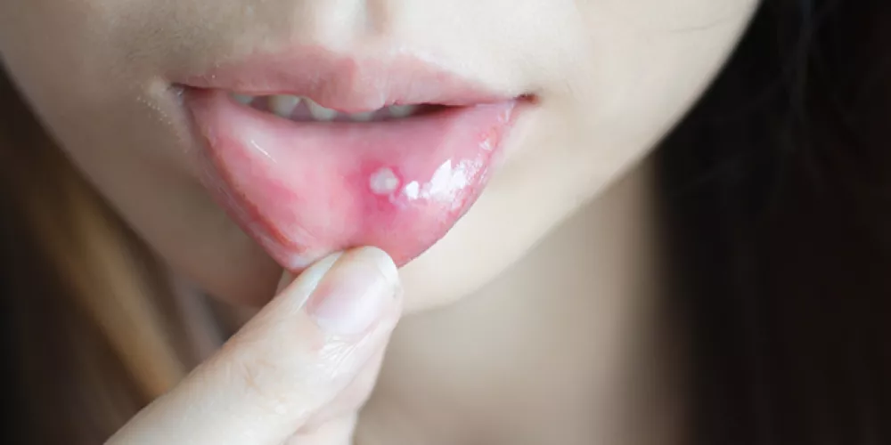 ما هي أنواع حبوب الفم؟