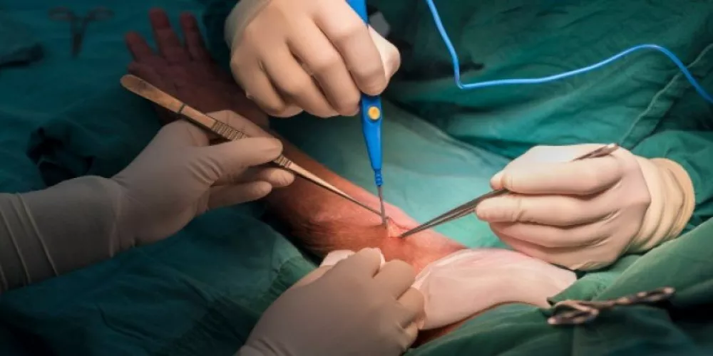 جراحة علاج السمنة لإنقاص الوزن (Bariatric surgery) | الطبي
