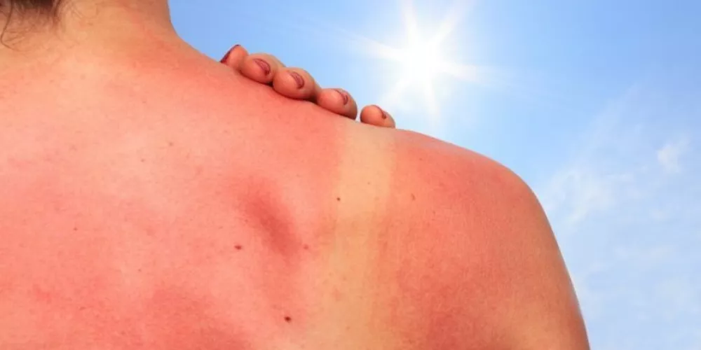 حرق الشمس (Sunburn) | اسباب اعراض علاج | الطبي