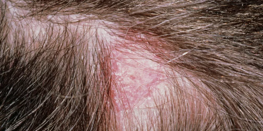 افات فروة الراس Scalp Lesion اسباب اعراض علاج الطبي