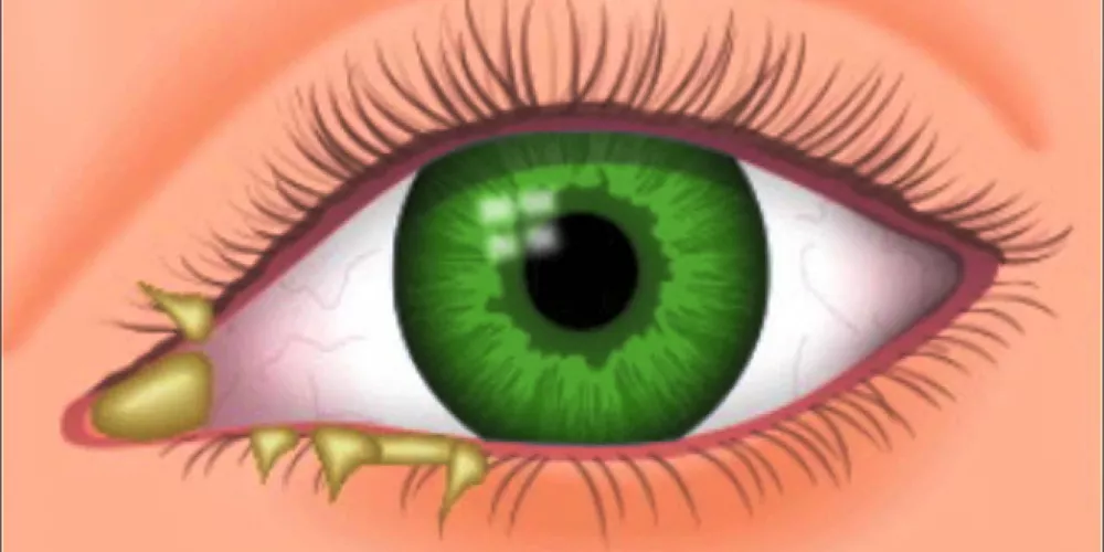 رمد العين التهاب الملتحمة