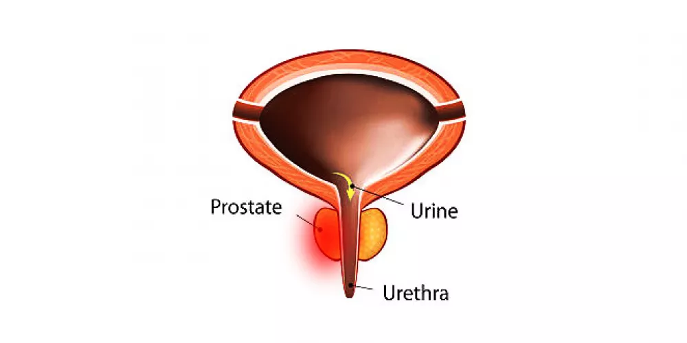Prostatitis influenza után, Prostatitis boris ugrás, Рубрика: Prosztatagyulladás