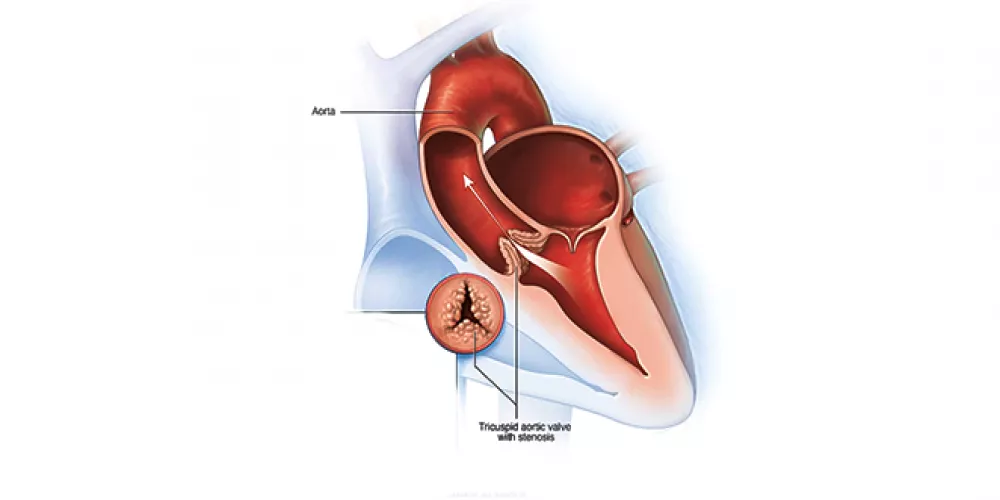 تضيق الابهر،تضيق الصمام الابهري ( Aortic stenosis ) | الطبي
