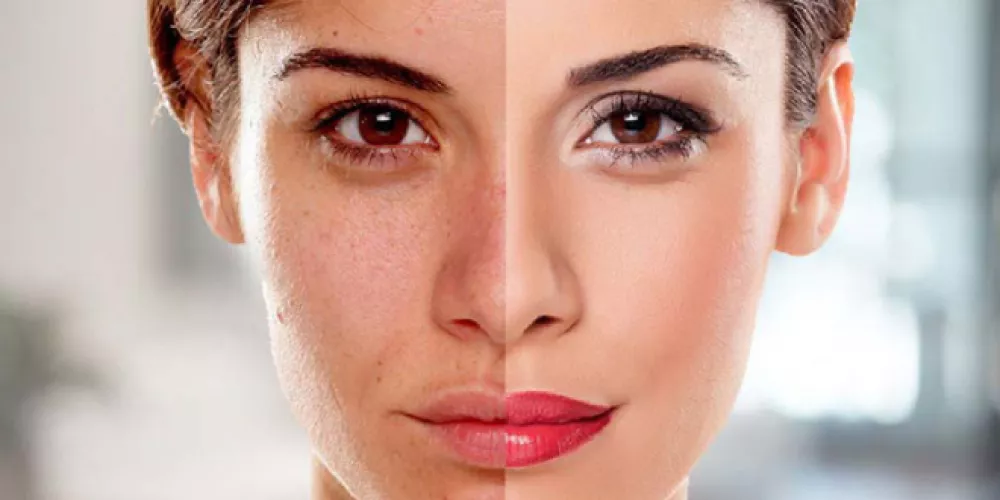 Koji su načini posvjetljivanja kože | medicinski