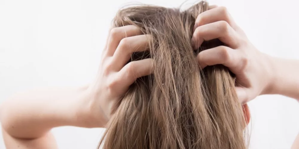 علاج صدفية الرأس