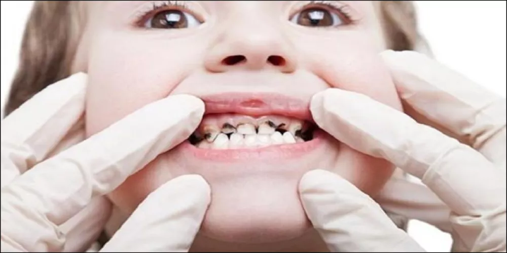 ما هي طرق علاج تسوس الاسنان عند الاطفال في المنزل | الطبي