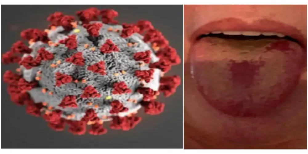اكتشاف أعراض جديدة وغريبة لمرض فيروس كورونا
