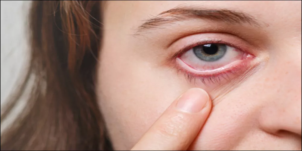 ارتباط  شدة الاصابة بفيروس كورونا بمشاكل خطيرة قد تصيب العينين