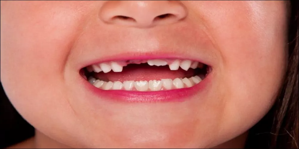 Dents ébréchées, causes des dents ébréchées, traitement des dents ébréchées | Médical