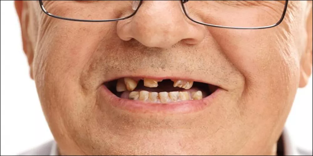 دراسة: فقدان الاسنان قد يزيد خطر الاصابة بالخرف