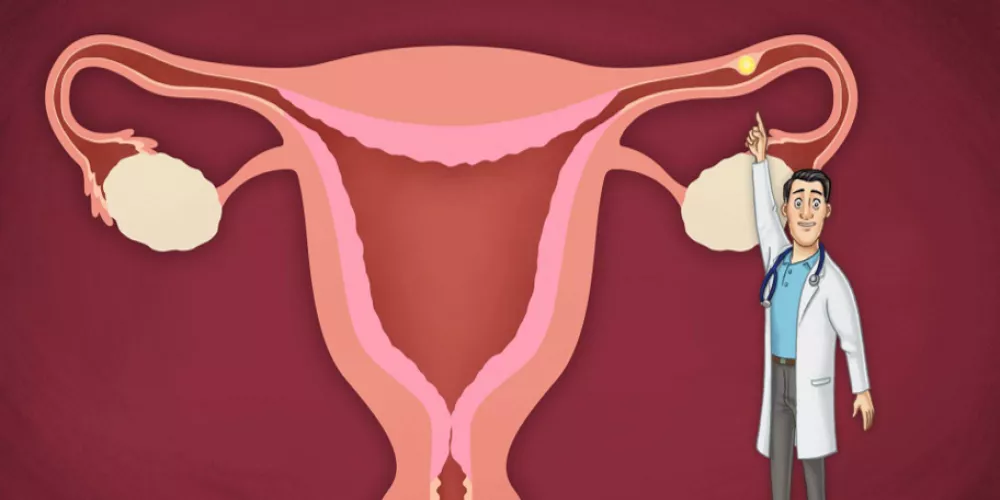 الحمل خارج الرحم عند النساء