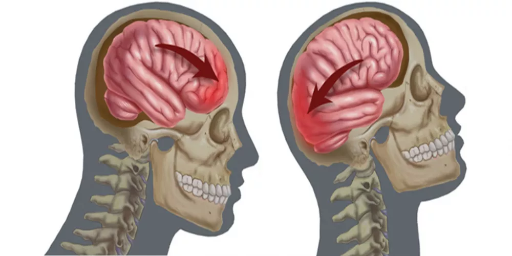  أعراض قالتة وخطيرة تشير إلى الإصابة بارتجاج المخ