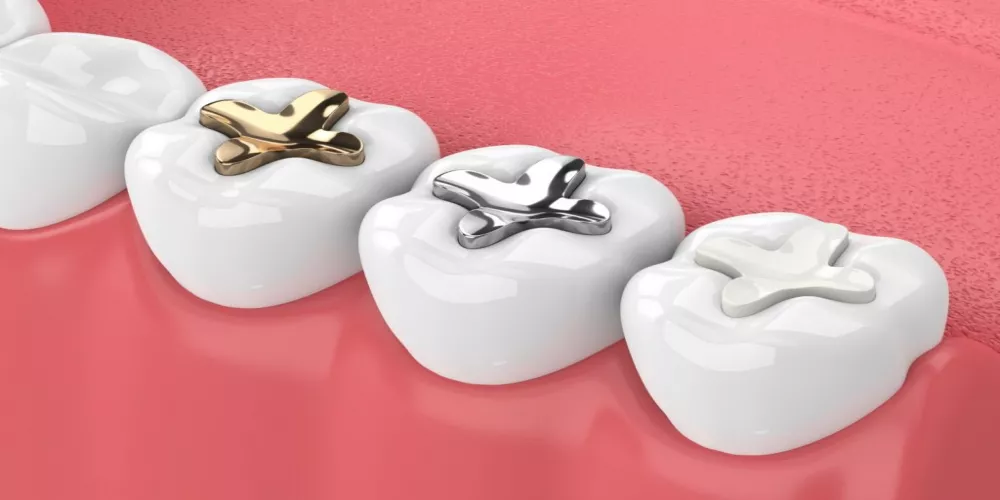 انواع حشوة الاسنان والفرق بينها واي منهم هو الافضل