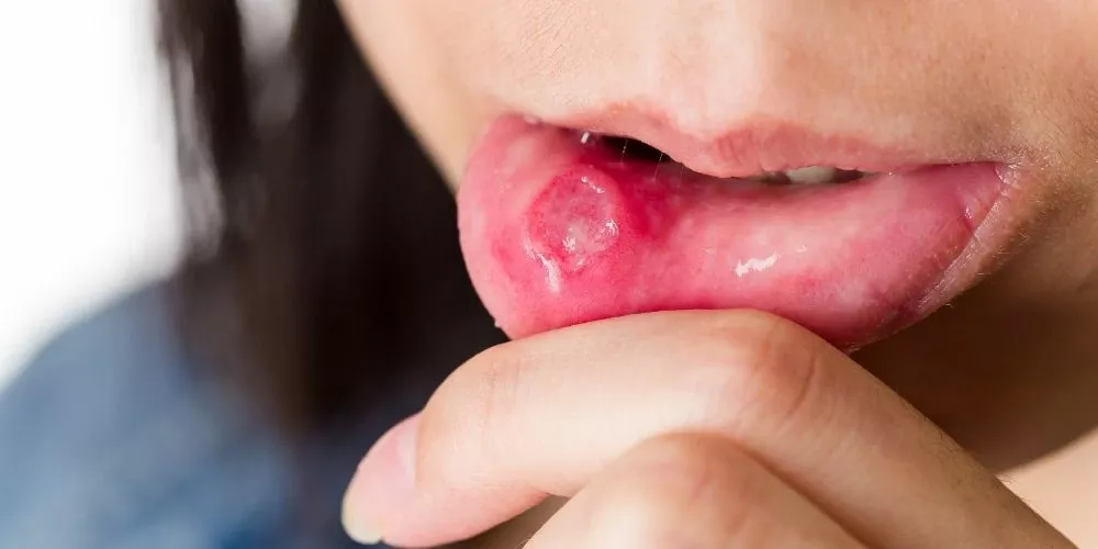 Kokios yra burnos opų priežastys ir gydymo metodai? Medicinos