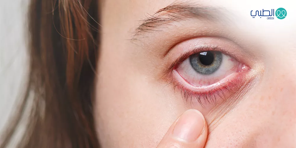 إلتهاب الملتحمة الربيعي (الرمد الربيعي)    