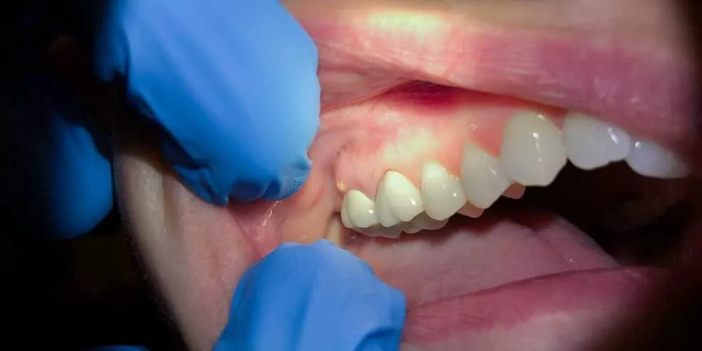 علاج الخراج الاسنان بالمره