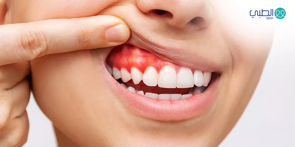 أمراض اللثة والأنسجة الداعمة وكيفية علاجها