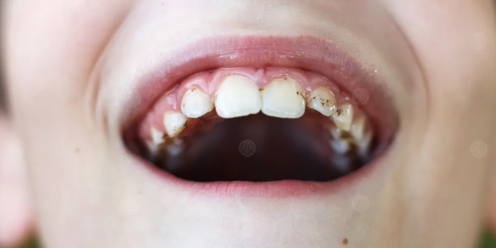دراسة تربط بين تسوس الأسنان، أمراض اللثة، والسكتة الدماغية