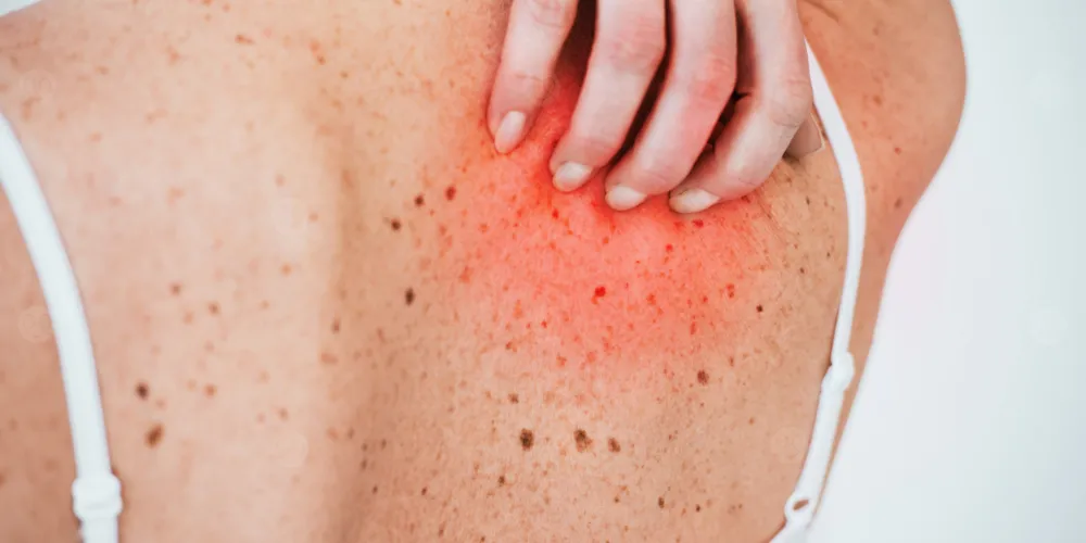 كل ما تحتاج معرفته عن أسباب حكة الجسم المفاجئة عند المرأة