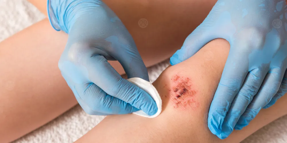 طرق الوقاية من تسمم الدم: دليلك لتجنّب العدوى!